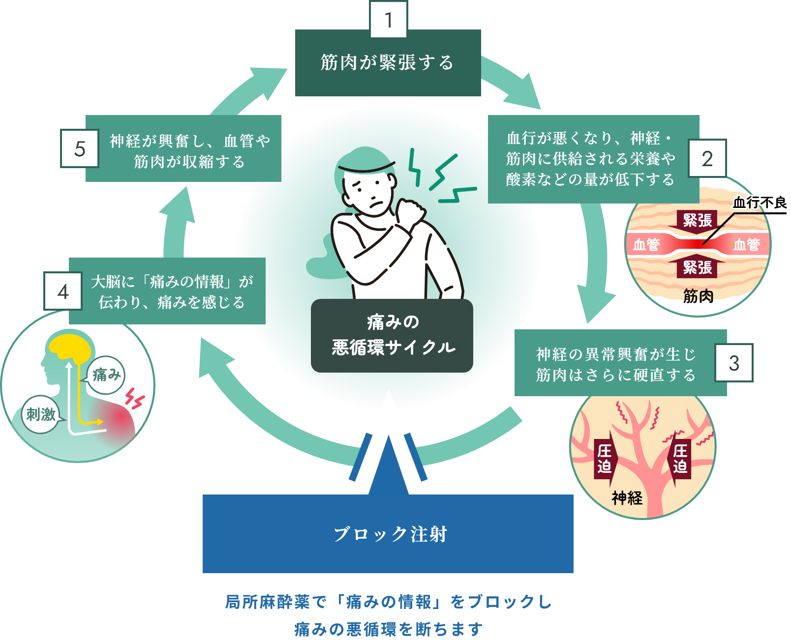 痛みの悪循環サイクル